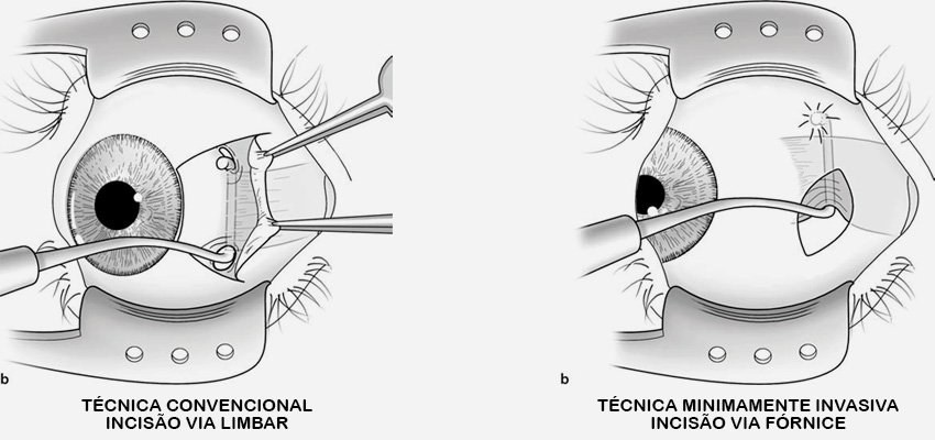 Ilustração comparando a incisão via límbica e a incisão via fórnice.